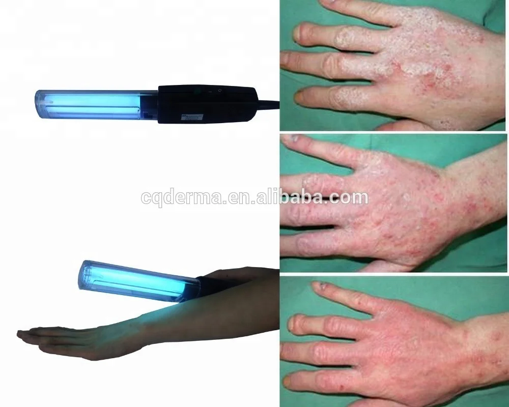 UVB Phototherapy Lamps UV Photoherapy Light Lampp 311nm Narrowband for Home Use  For Psoriasis Vitiligo Treatment