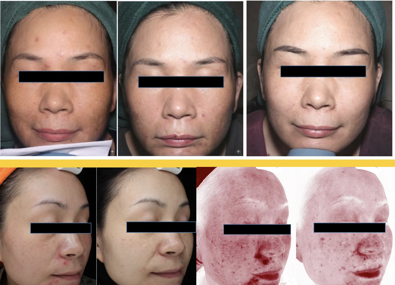 DJMportable 3d AI face skin Diagnostics analyzer facial Tester scanner magic face mirror  skin analysis machine with camera