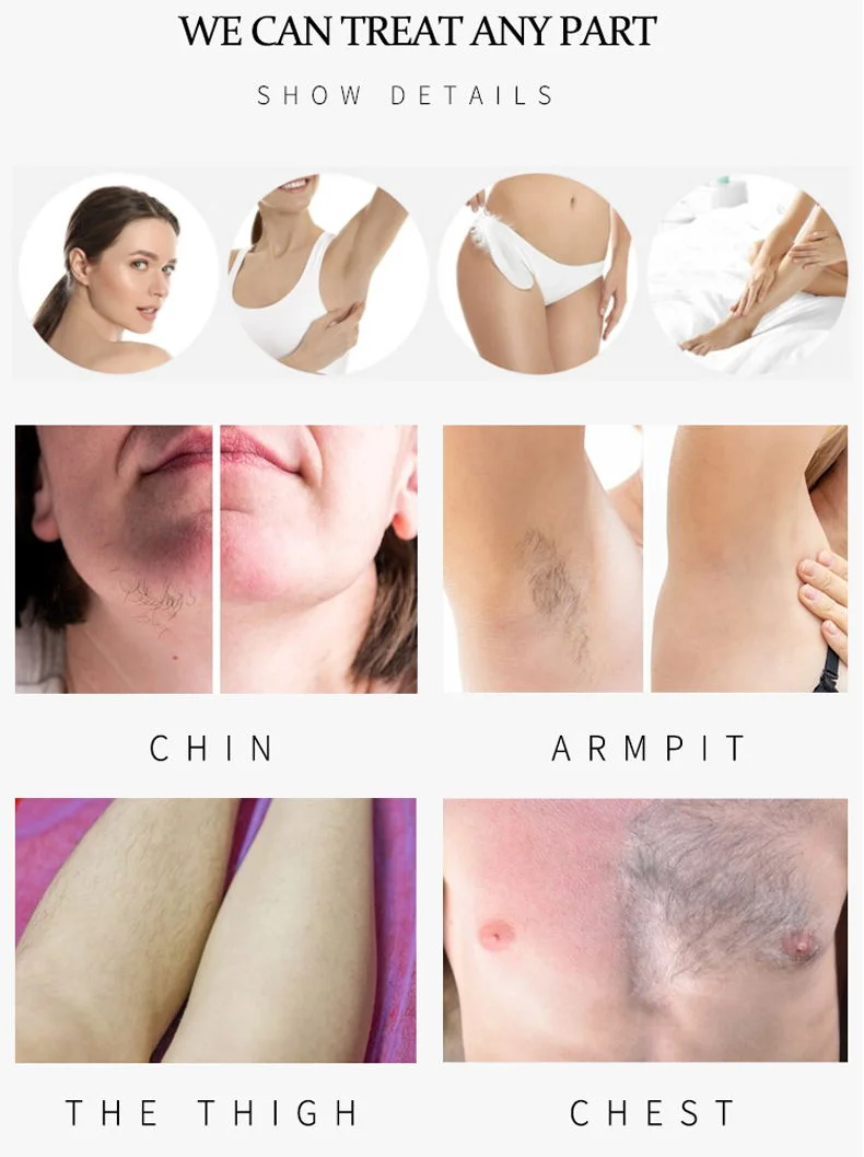 Medical Ce Approved Trio 755 808 1064nm  Titanium Platinum Ice Laser Diode Hair Removal Machine System Permanently