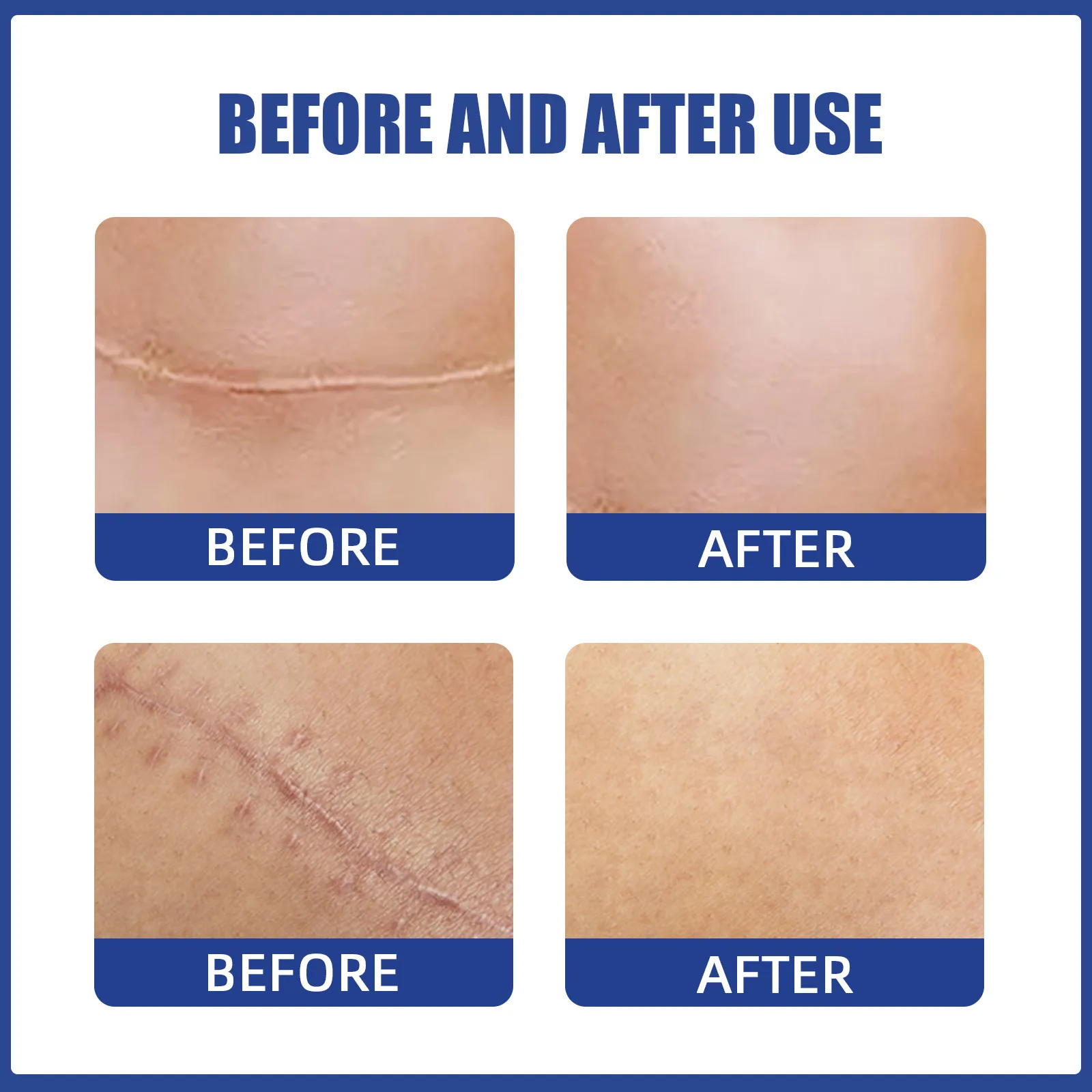 Breast Scar Sheet Areola Flattening Lightening and Softening for Breast Surgery Breast Scar Patch