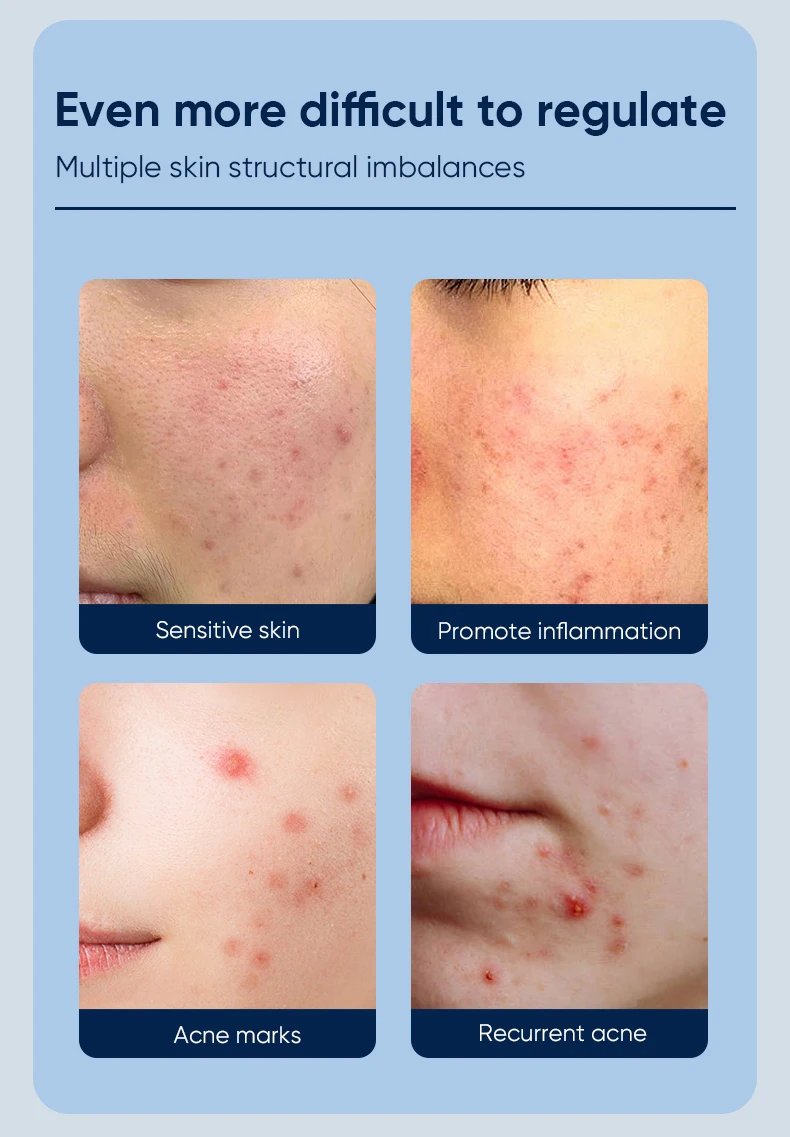 MOIKA private label quick anti acne salicylic acid face gel pimples scars treatment herbal acne removal gel