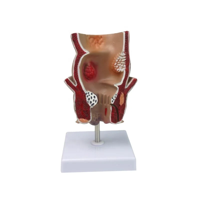 Анатомическая модель болезни геморроя аноректальная патология с внутренним наружным геморроем Анальная фистула модель тренировки трещинки