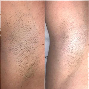 Seek Agents laser hair removal machine professional portable medical808