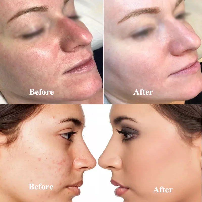 Ampoule BB Cream Glow Dermawhite Face Serum Essence Foundation Beauty Brightening Whitening Anti-Wrinkle Acne MTS Microneedle