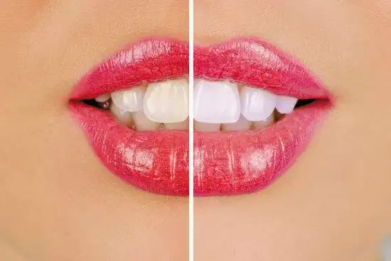 35%CP Professional Teeth Whitening Bleaching System Bright White Tooth Whitening Gel Remove Yellow stain