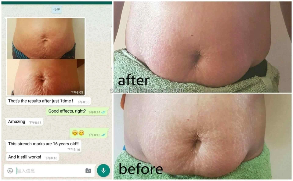 Lipo laser review