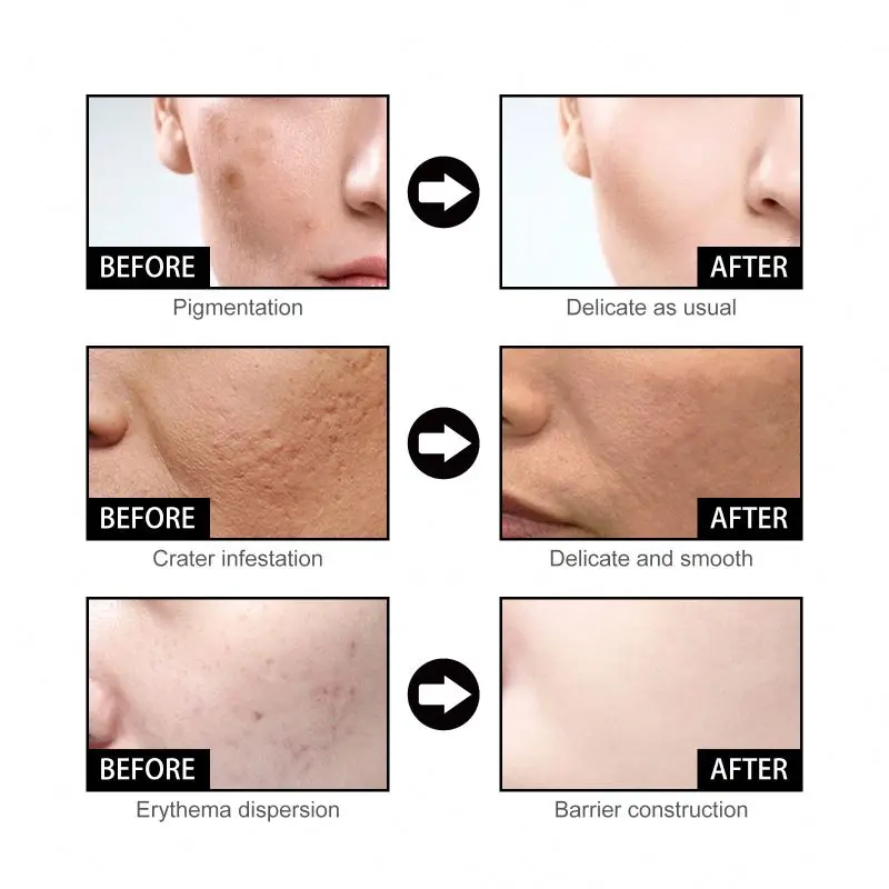 EELHOE Nicotinic Acid Facial to Weaken Acne Marks Moisturize Pores Shrink and Whiten Skin Essence