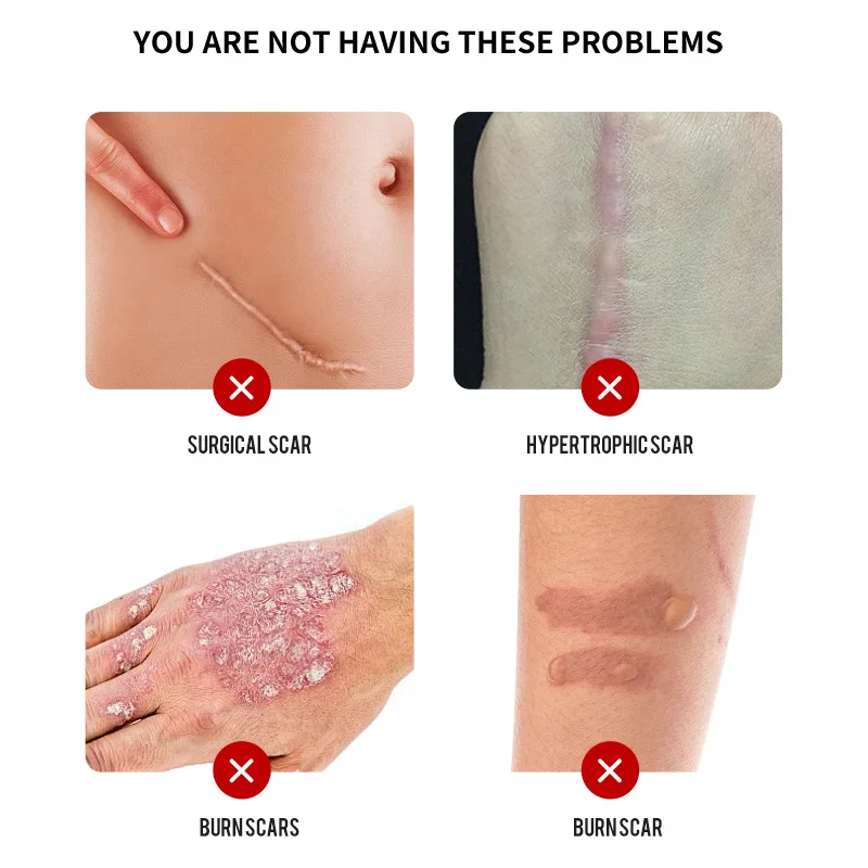Skin scar cream 20g per tube soothes skin surgical scar hyperplasia scar burn discomfort