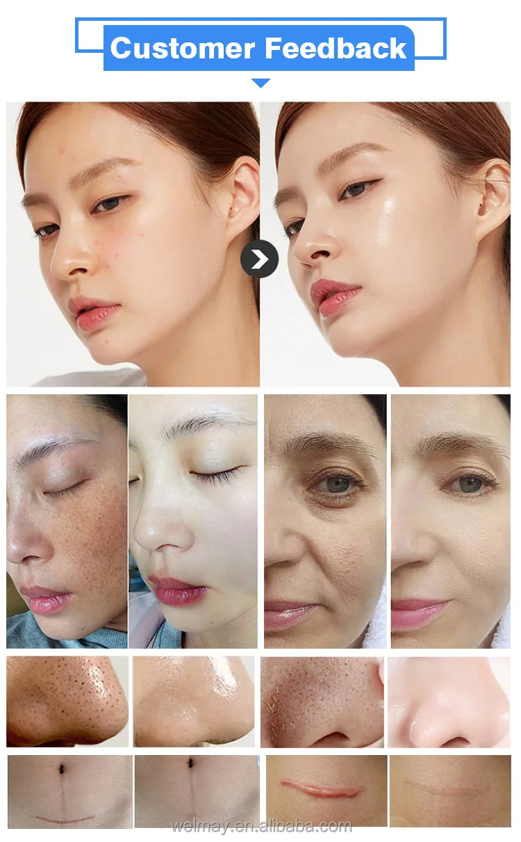 7 Tips 1MHZ RF Radio Frequency Machine Monopolar RF Face Skin Tightening Radio Frequency Ablation Beauty Device