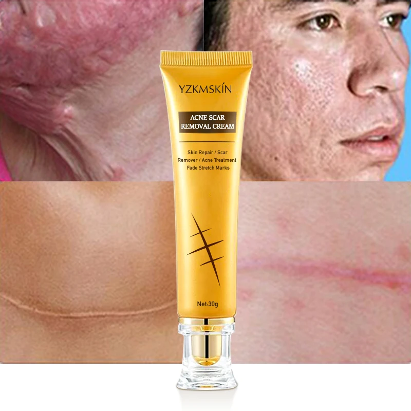 Крем для удаления шрамов от акне, темных точек, прыщей и шрамов