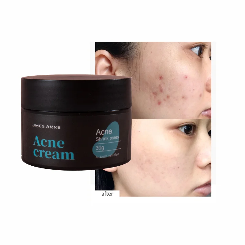Best Acne Treatment Retinol Cream For Post-Acne Marks Brightening Non Comedogenic