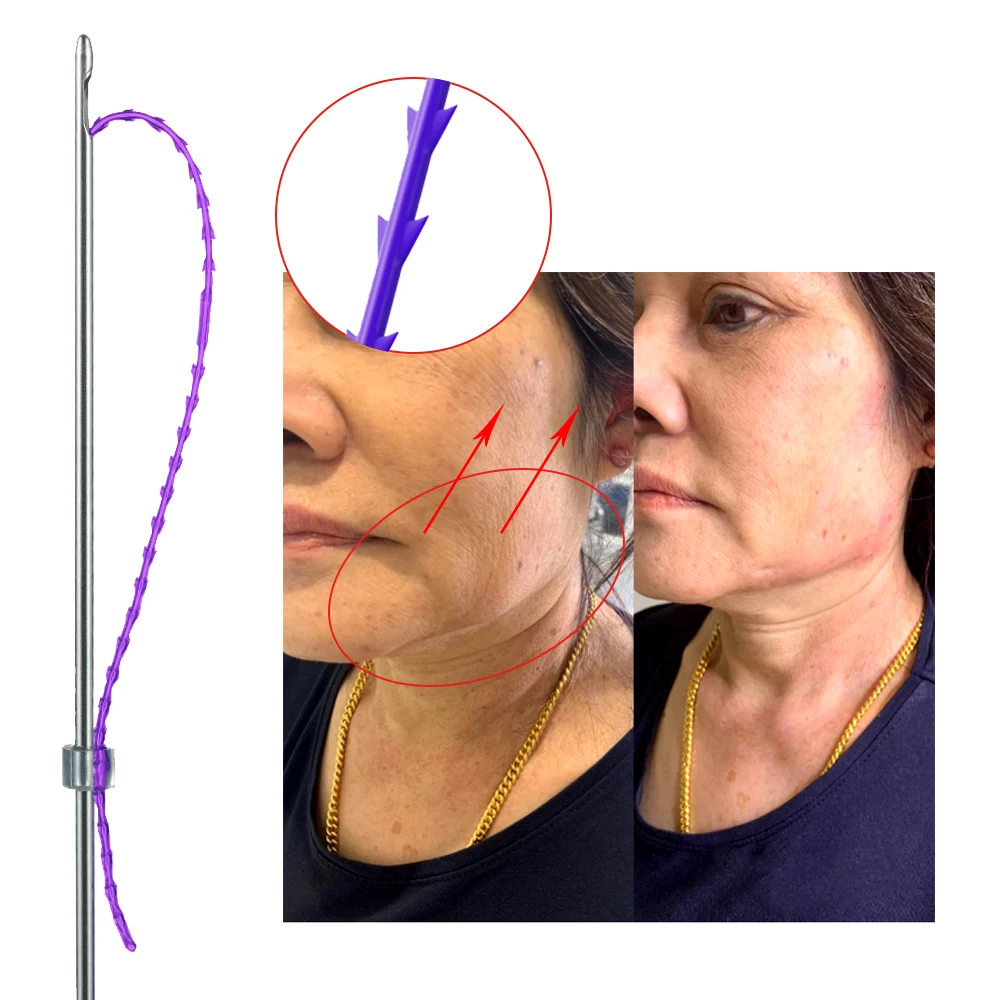 Korea Mesh Nose Berbed Screw Facial Lifting Shark Teeth Molding Thread 4D PDO Cog