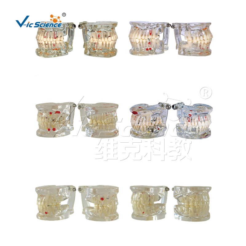 diseased teeth and gums anatomy model big size teeth dental teaching model