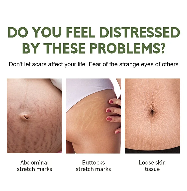 Wholesale Color Removal Tightening Skin Repairing Skin Care Stretch Marks Removal Cream For Body