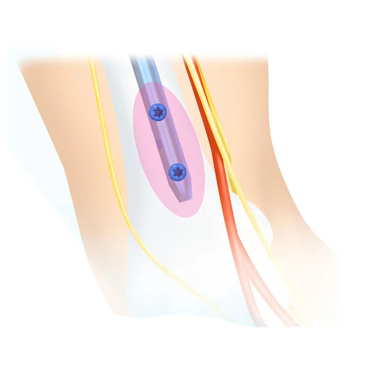 Trauma Orthopedic Implants Interlocking Titanium Nail Multi-Lock Humeral Intramedullary Nail