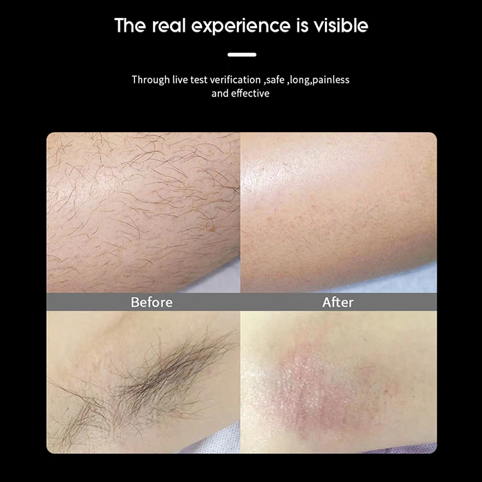 Brand new listing laser hair removal 808 diode laser hair removal 3 wave 755nm 808nm 1064nm diode laser machine