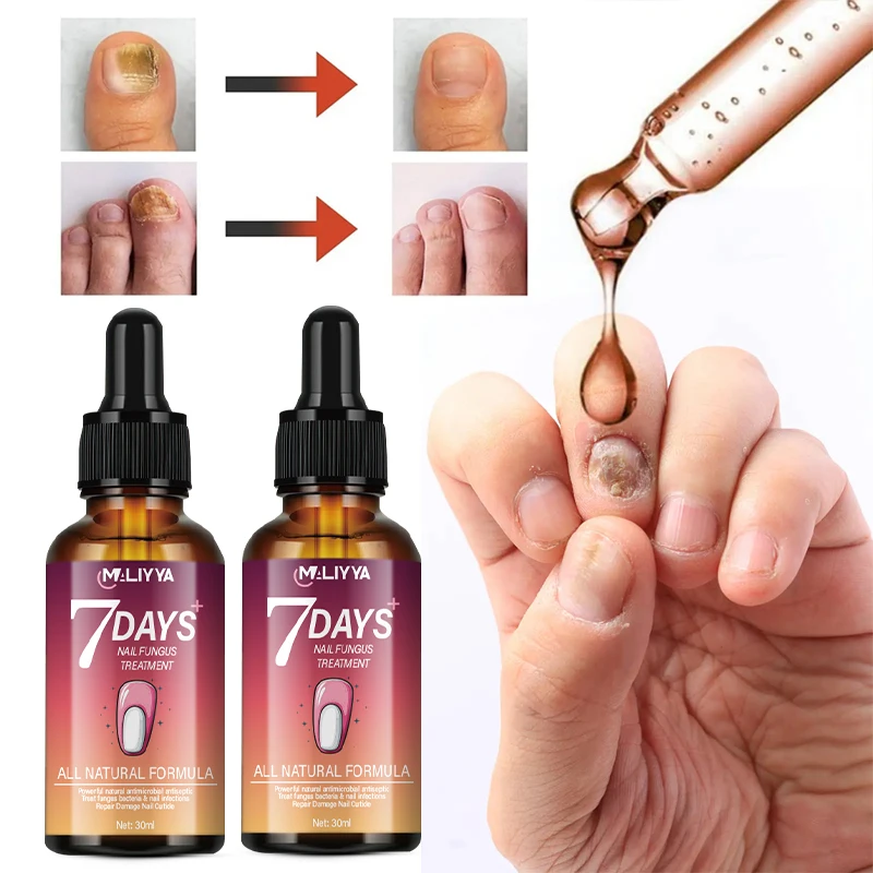 Private Label 7 Day Nail Fungus Treatment Essence Repair Bacteria Rough Nail Discoloration Brittle Nail Care Repair Essence