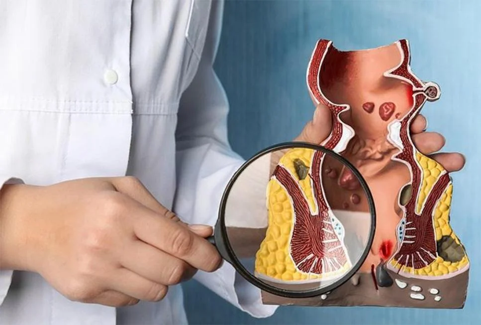 Cherylas1470nm 15w Surgical Diode Laser for Hemorrhoids & Fistula Surgery treatment