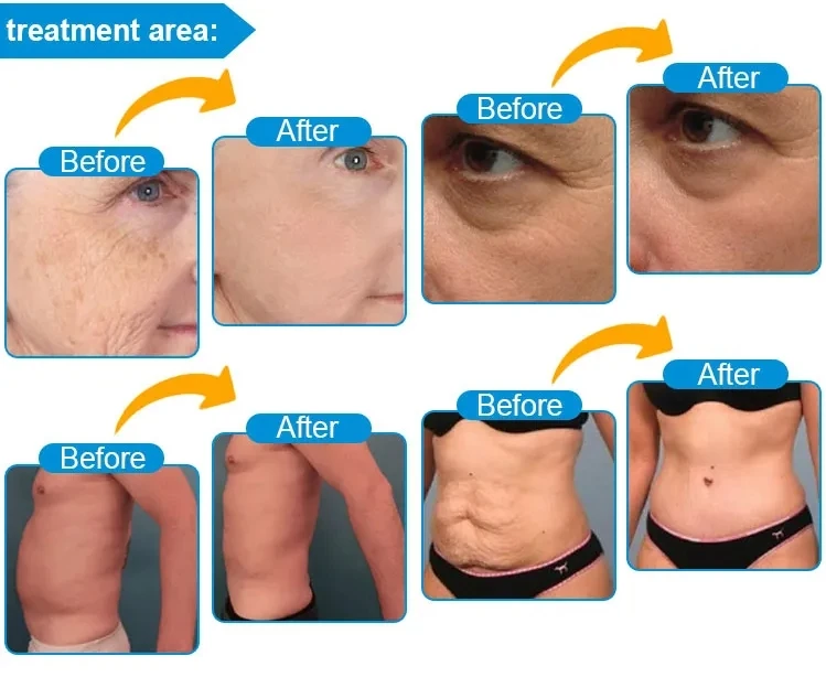 Medical CE korea hifu 3.0mm/4.5mm facial smas lifting hifu skin tightening hifu machine price