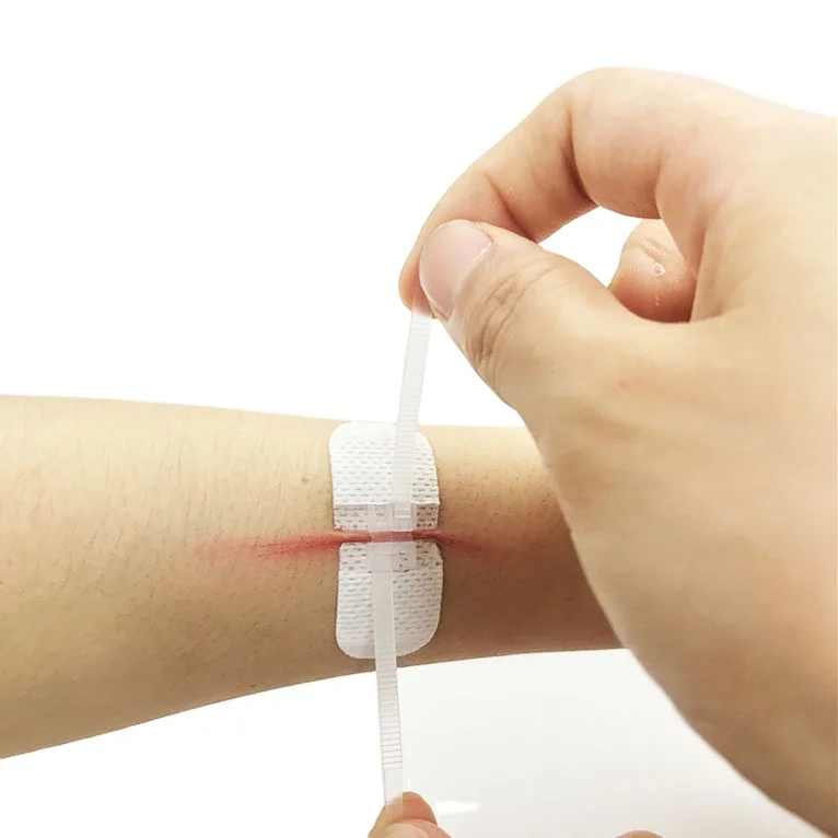 
 Раны закрытие соединения заживления кожных ран застежка раны устройства  