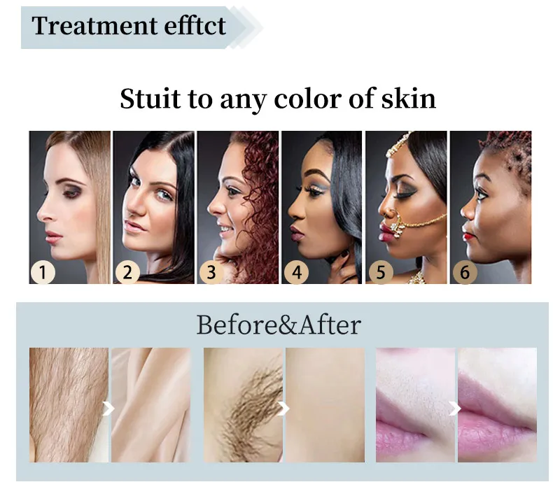 Portable 808nm 2000W Mini Diode Laser Hair Removal Machine Home Use Laser Diodo