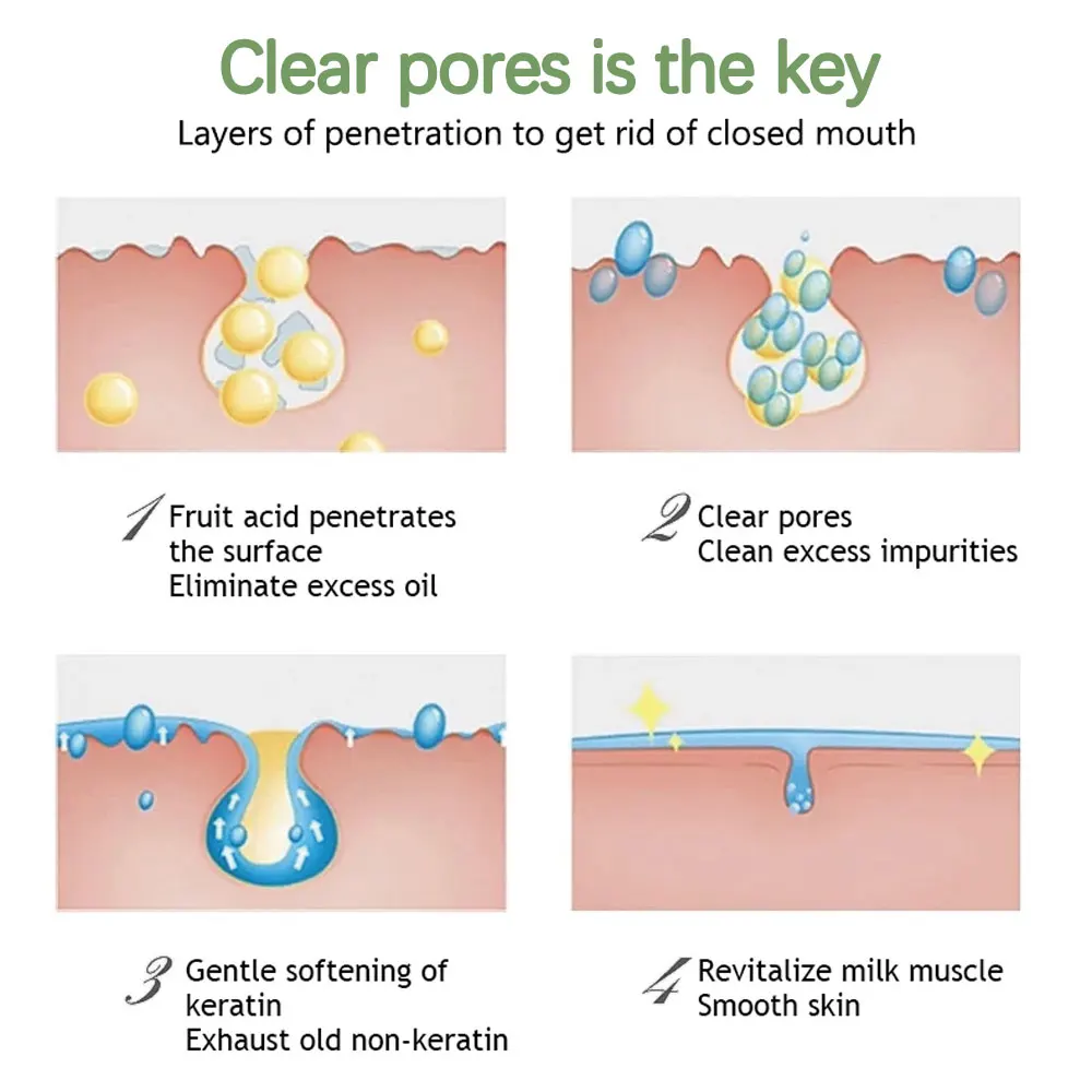 20% Vitamin C Retinol Tumeric Aloe Vera Facial Anti Acne Pore Serum Solutions 15 Ml