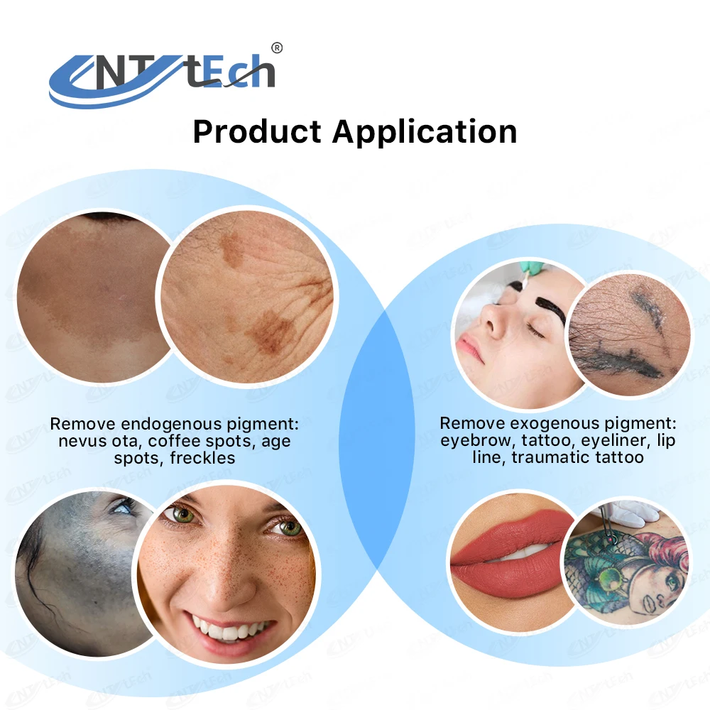 Hot Selling 1064nm 532nm nd yag laser q switched nd yag laser tattoo removal machine prices