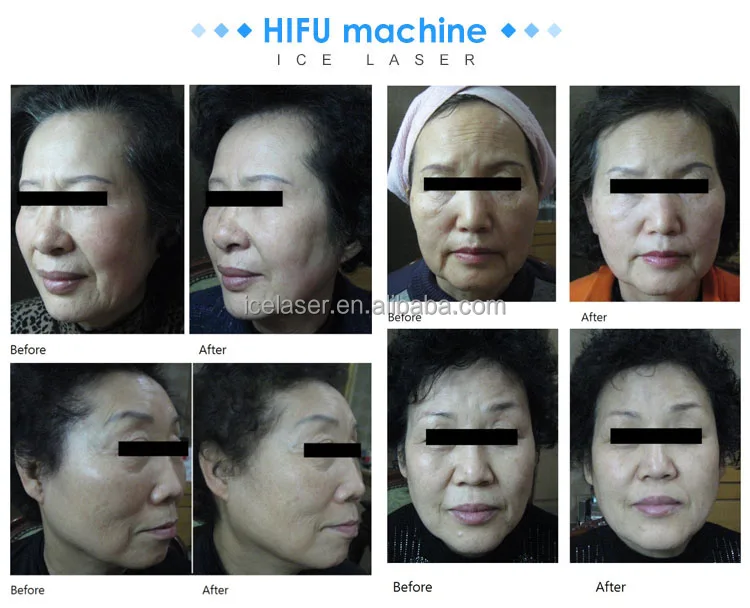 korea hifu 7d new.jpg