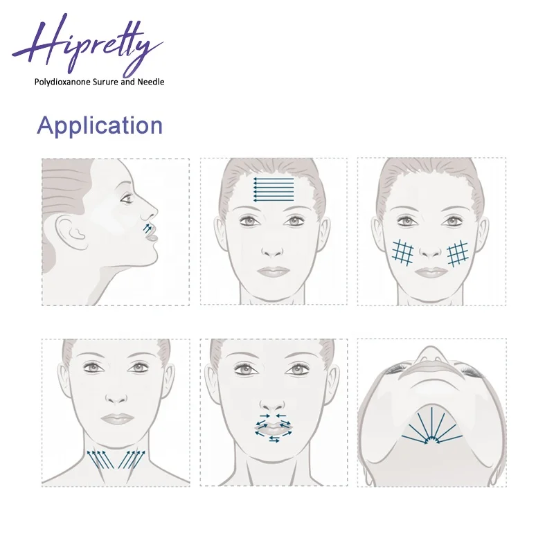 mono 26g 90mm Medical Disposable absorbable surgical suture needle polyglycolic acid &polydioxanone monofilament