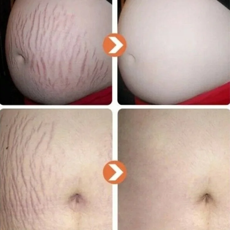 100ml Private Label Stretch Mark Scar Oil Vitamin E & Collagen Skin Firming Body Oil Stretch Mark Removal Oil
