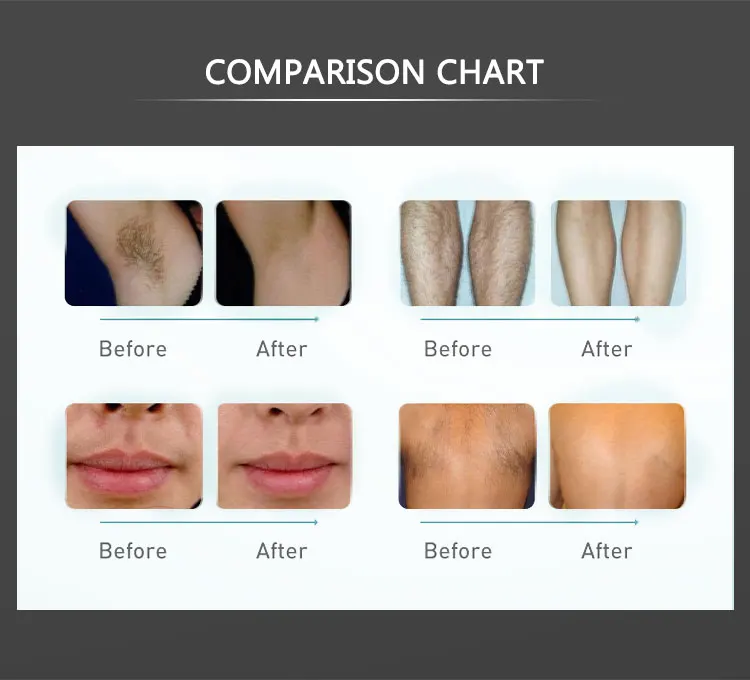 2024 best ipl laser hair removal device opt dpl fast hair removal system factory price