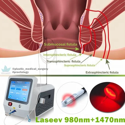 2023 factory price fiber laser 1470nm 980nm proctology equipment for hemorrhoids anal fistula removal