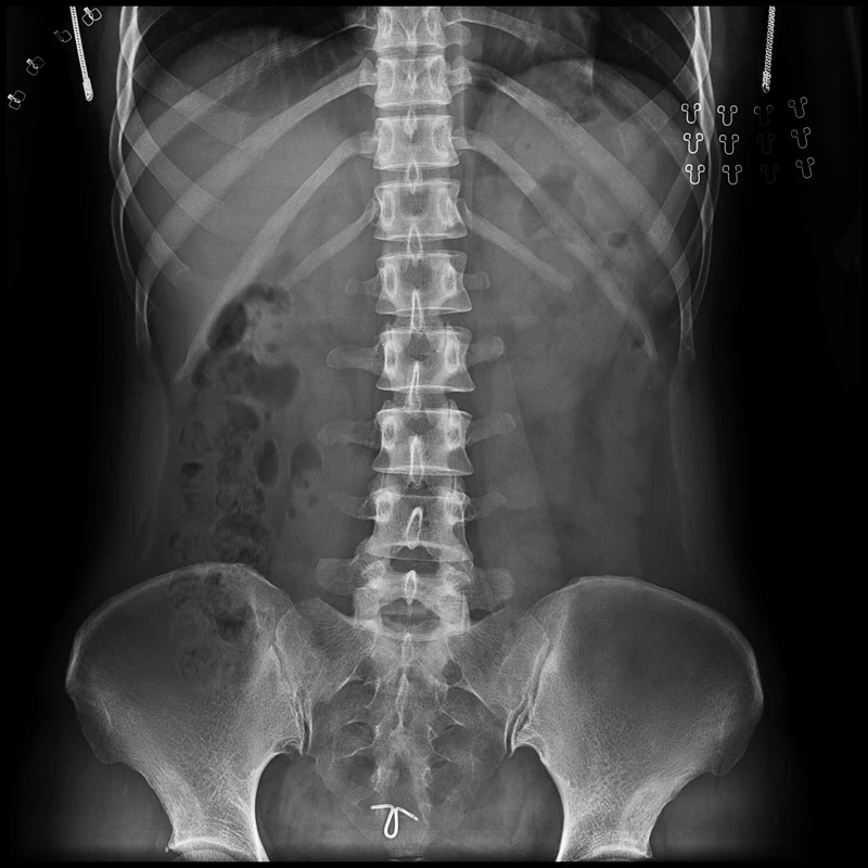 Medical Wired 17*17 Fix Mounted Digital Flat Panel Detector X Ray DR  for Human and Veterinary Diagnostic Radiography