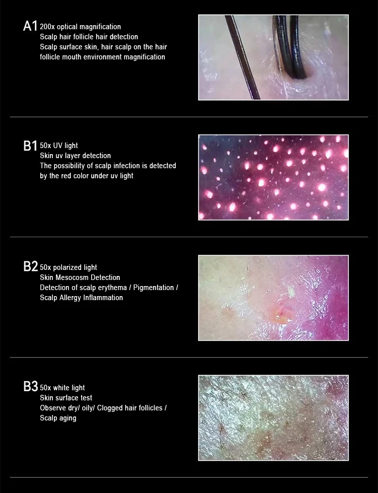 Analyzer Scalp Camera For Hair Mineral Analysis Machine Hair And Skin Analyser For Hair Analysing For Computer Or Mobile