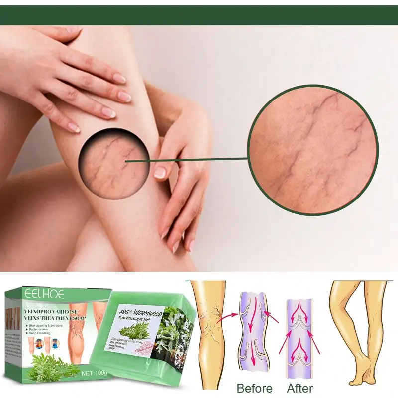 Hot Sale - VeinoPro Varicose-Veins Treatment Soap