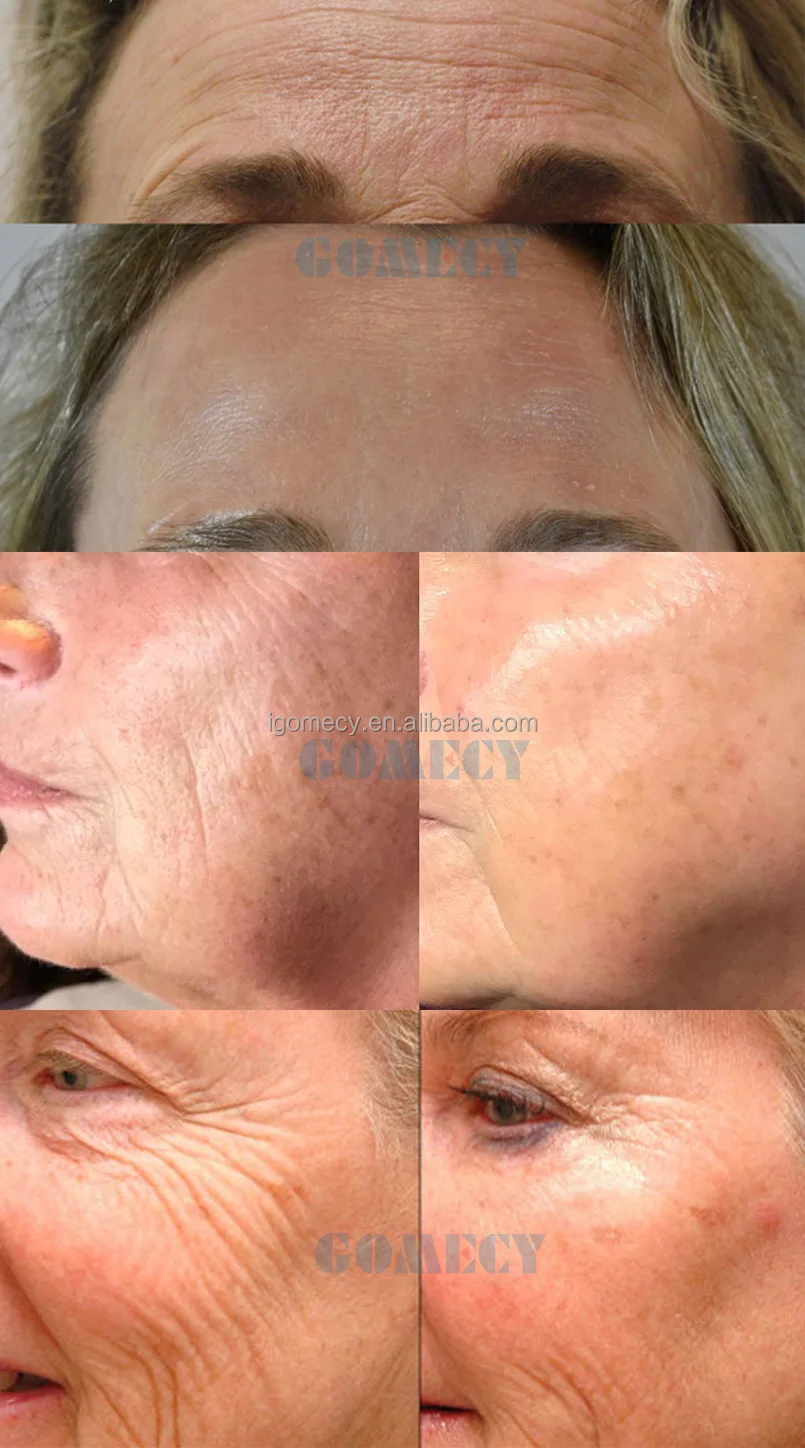 gomecy-professional-wrinkle-removal-rf-face-lifting-pe-face-emfacings-machine-for-face-peface-skin-tightening-machine