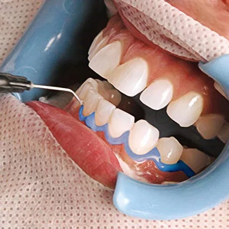 CE Approved 1.5/3ml Home Use Teeth Whitening Gel Gingival Barrier Gum Protective Dental Gum Protector