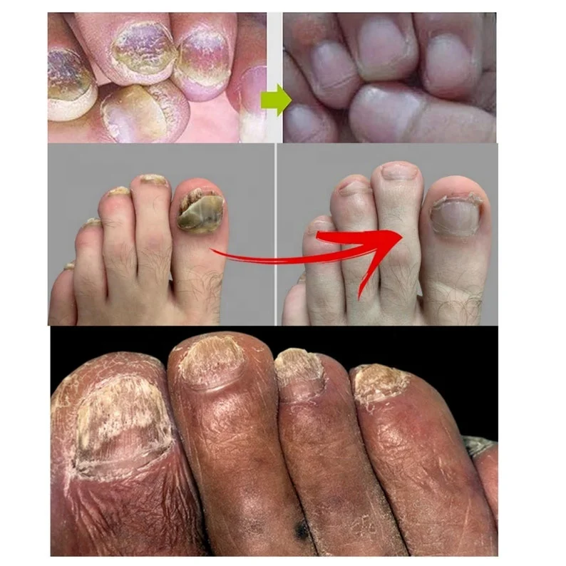 Customized Nail Fungus Oil Beautiful Healthy Nail Care Nail Fungal Treatment Serum for Hand Foot Removal Repair Gel