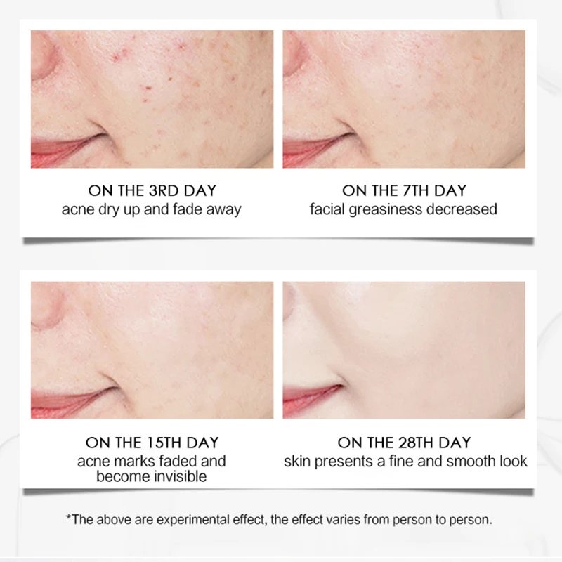 Enhances brightness herbal essence acne scar removal cream deep acne scar removal stretch mark cream oil control anti acne cream