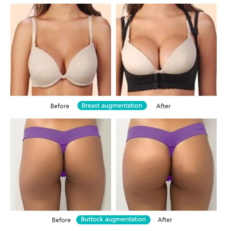 
Low price hyaloronic acid dermal filler 20ml inyecciones para levantar gluteos 