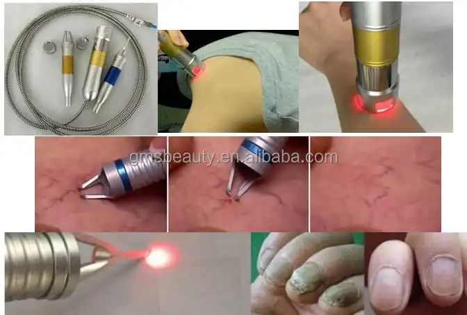 New invention product 980nm 905nm laser toenail nail fungus treatment machine