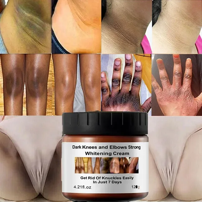 Private Label Best Strong Instant Whitening Cream for Dark Knees Knuckles and Elbows Fast Action Extreme Whitening Cream
