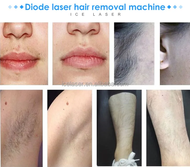 laser hair removal machine