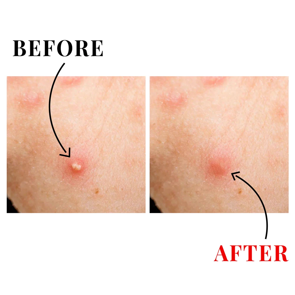 OEM ODM Manufacturer Private Label Hydrocolloid Acne Pimple Patch