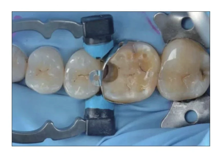 NEW TYPE Dental Tools Autoclavable Matrix Clip Dental NITI Clamps Separating Ring