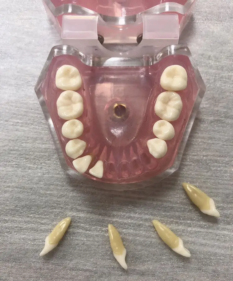 Dental Tooth Extraction Model with Soft Gum and Removable Teeth