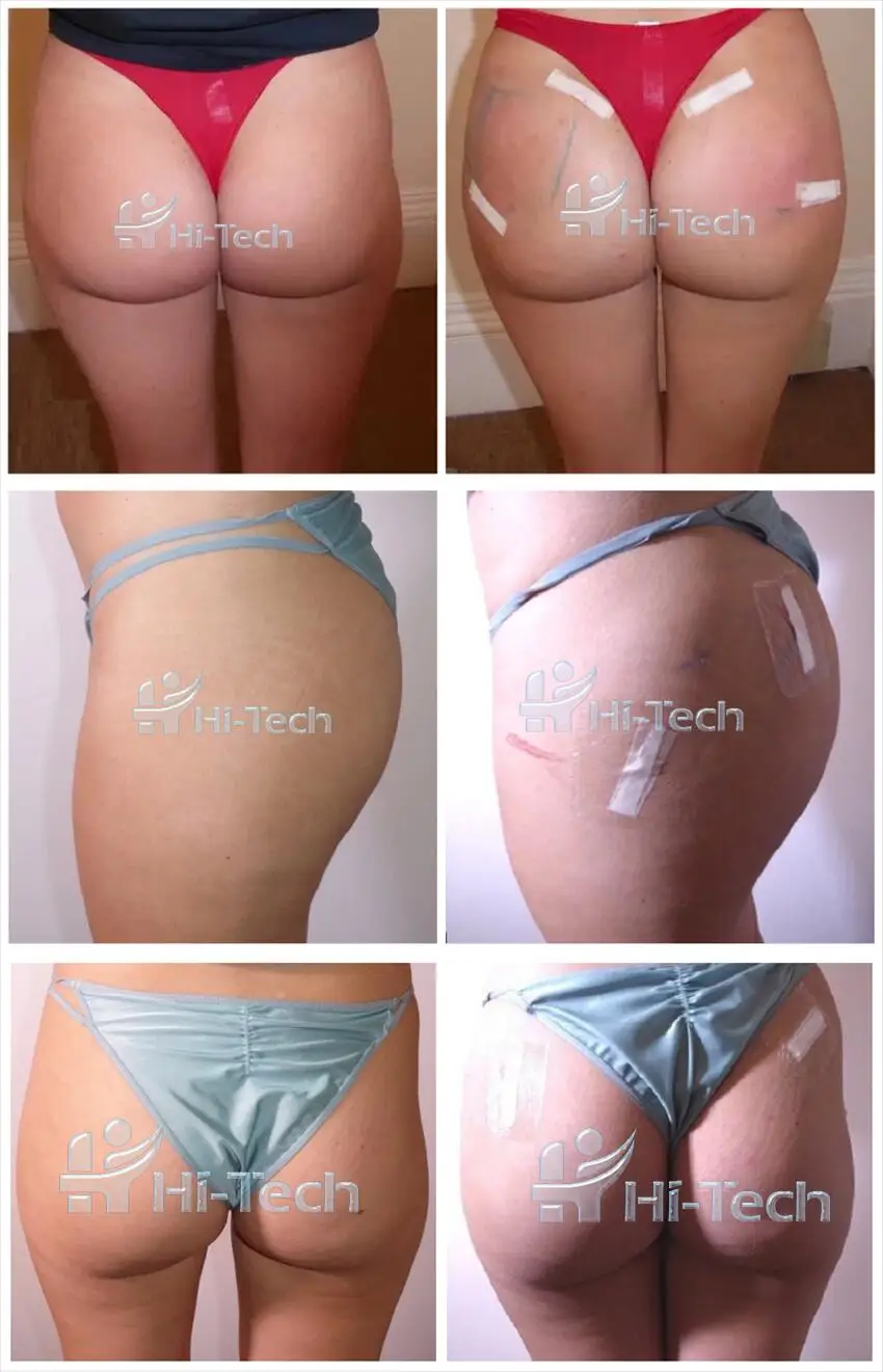 Korean TOP-Q Filler Hyaluronic Acid Buttock Breast Increase Long Lasting Dermal Filler For Butt And Hips Enlargement Injections
