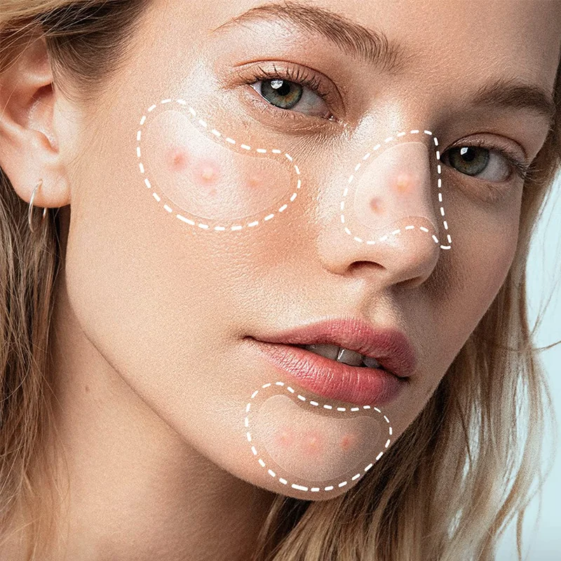 Cosmetics Vegan Hydrocolloid Spot Stickers Acne Patch Custom Logo Private Label Acne Patch