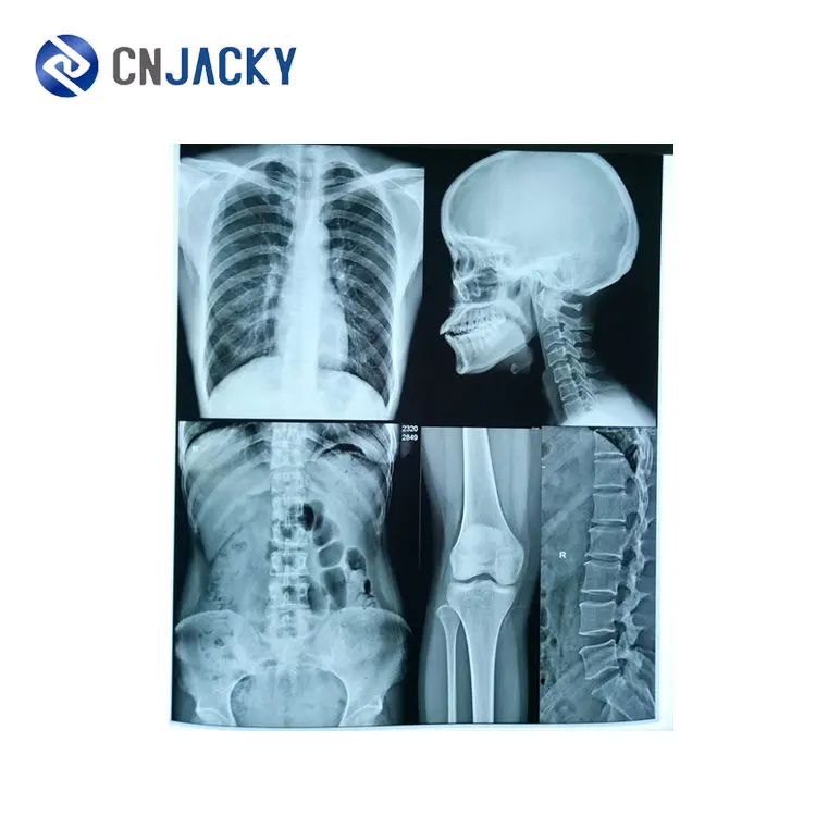 Digital laser blue printing medical film for hospital examination CT / CR / DR