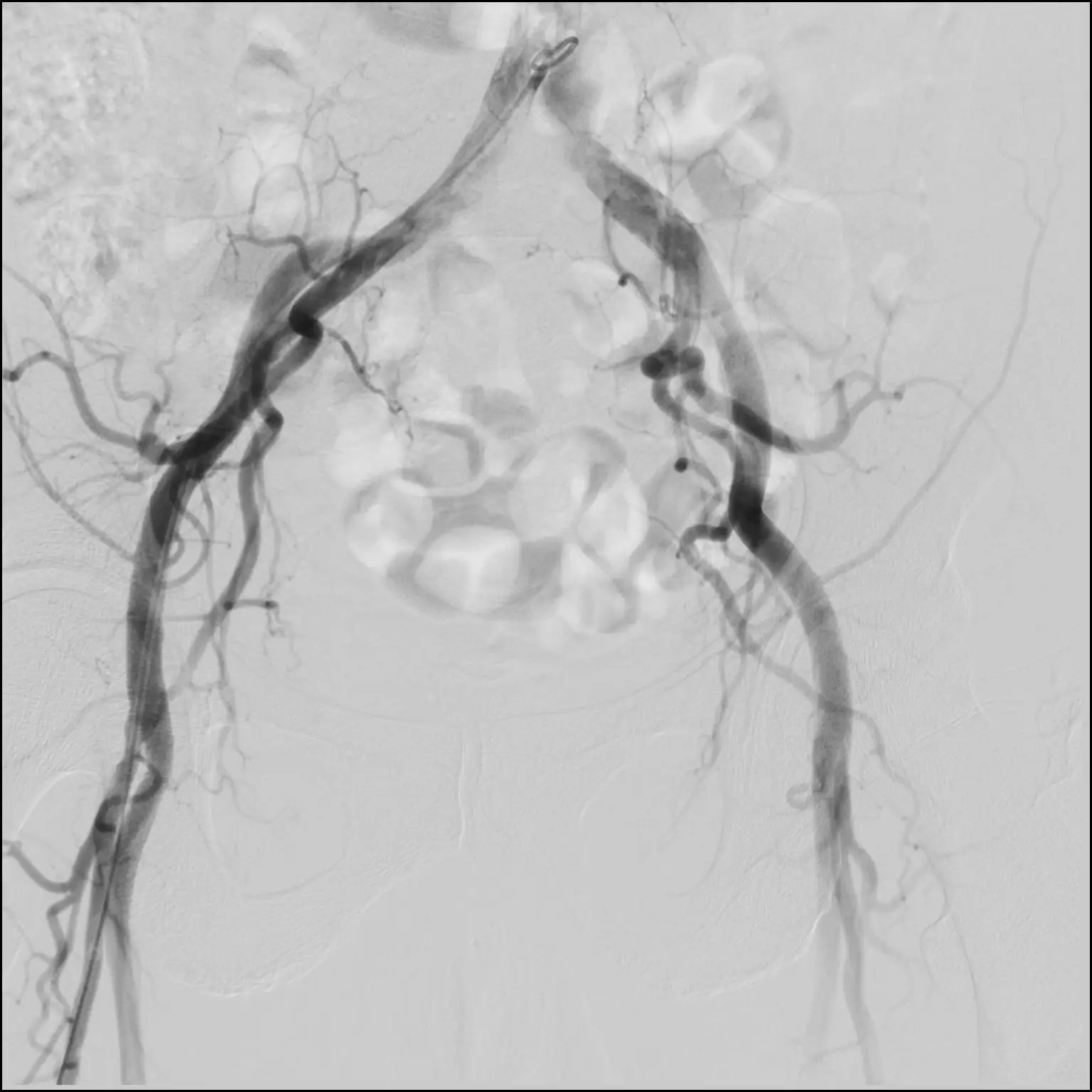 100 kw Imaging medical CE Approved C-arm X-Ray Fluoroscopy Radiology Angiography Machine with Liquid Metal Bearing X Ray Tube